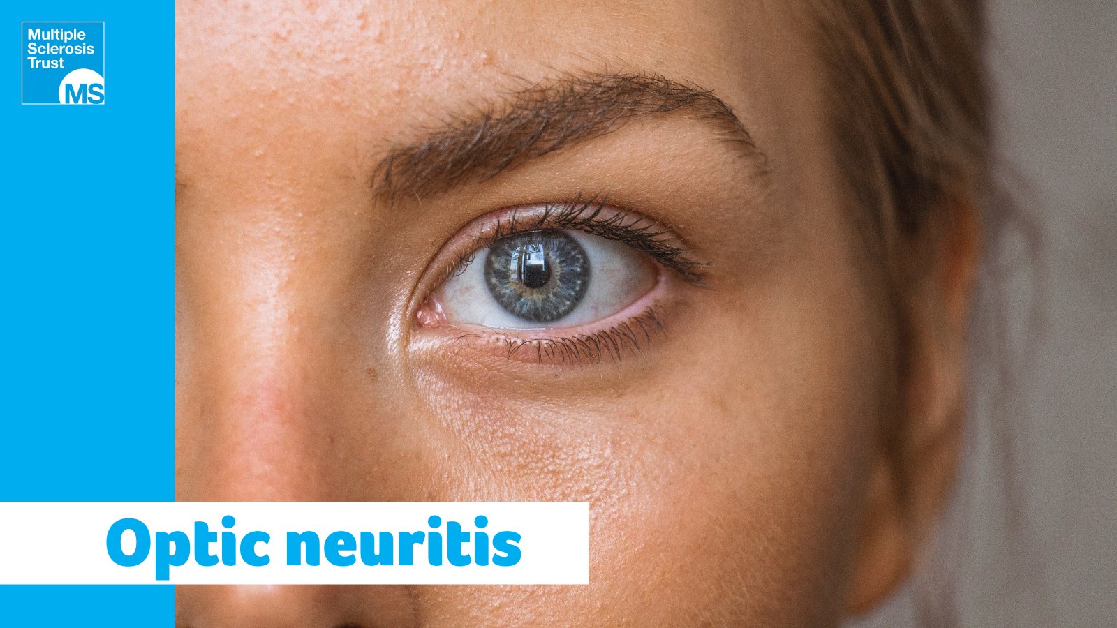 MSTrust on Twitter "One in four people with MS say OpticNeuritis was