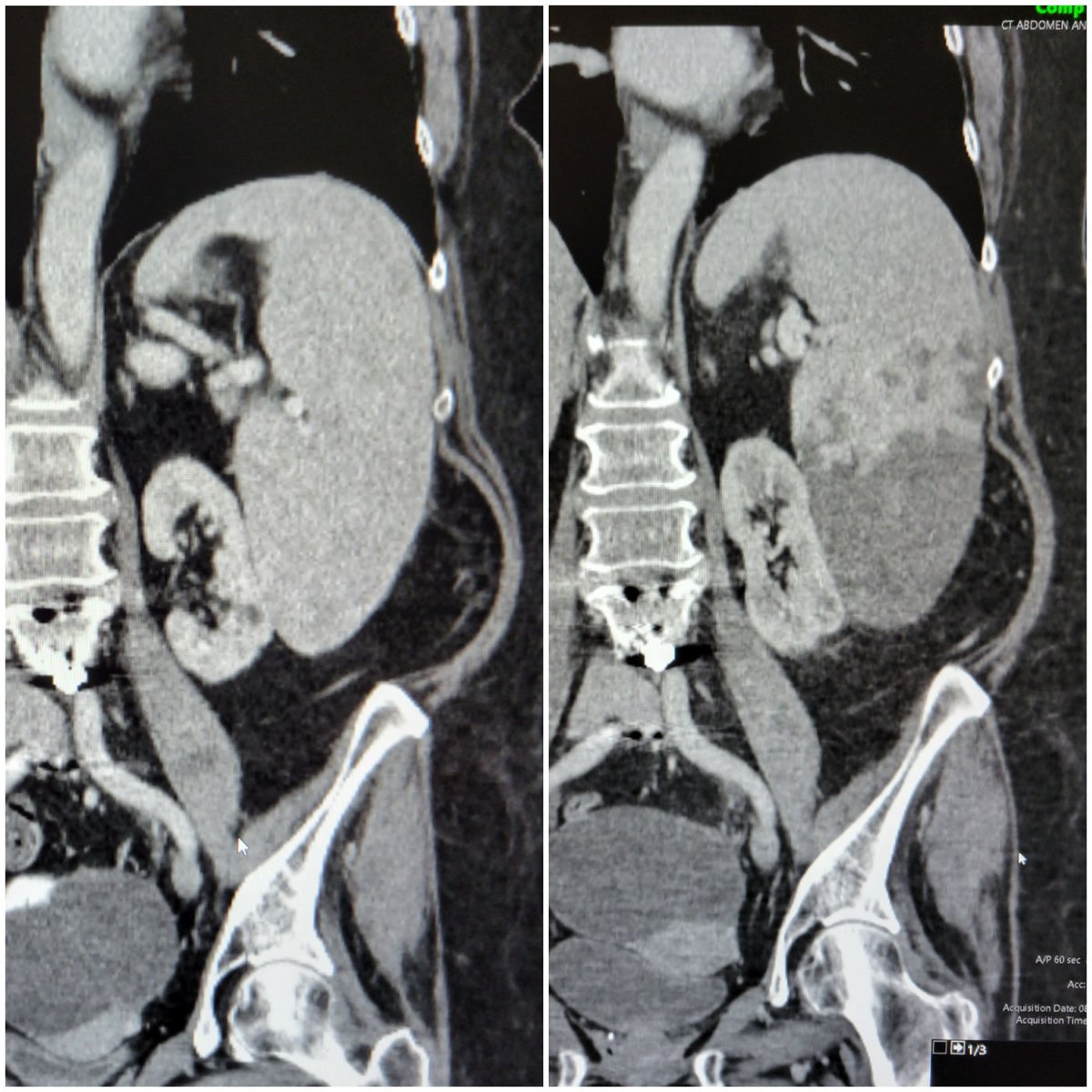 TempleRADs's tweet photo. Patient with splenomegaly and thrombocytopenia preventing chemotherapy treatment. Partial splenic embolization from radial approach with particles.30% infarct yielded 5 fold increase in platelets! Nice job Dr. Nameet Patel and @slee106. @TempleRadRes @SIR_ECS @SIRRFS #RadialFirst https://t.co/iV5ilI7Rir