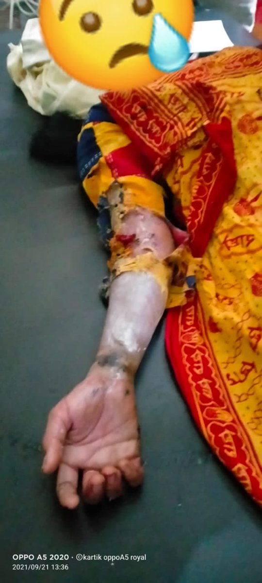 BhimArmyChief's tweet photo. यूपी में महिला सुरक्षा के सभी दावे झूठ है। जालौन में दुकान पर बैठी आकांक्षा सैनी पर अपराधियों ने सरेराह एसिड फेंककर उसे जलाने का प्रयास किया।

भाजपा राज में बेटियां रात के अंधेरे में भी जलाई जाती हैं और दिन के उजाले में भी। अभी तक आरोपी गिरफ्तार क्यों नही किए गए? @dgpup https://t.co/KKWjvkOvuC