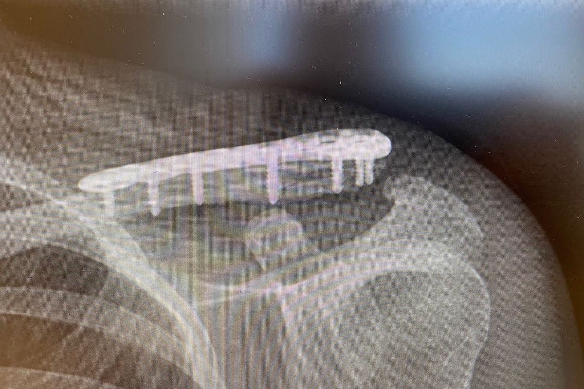 Not how I thought my Monday would go!! I was hit by a car out training on Monday morning and broke my collarbone and torn a few ligaments.. soo thankful I got straight into surgery and can focus on some good recovery now❤️ @StarcasinoTeam <a href="/TrainSharpJon/">trainSharp.co.uk</a> #backstronger #turbotime