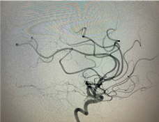 PenNeuro's tweet image. US HCPs: Glad Dr. Avinash Mesipam was able to experience #RED68! #REDglideDifference #RaisingTheStandard Rx only. For indications, contraindications, warnings, precautions &amp;amp; potential adverse events see bit.ly/2BYj7Yj Clinical results may vary.