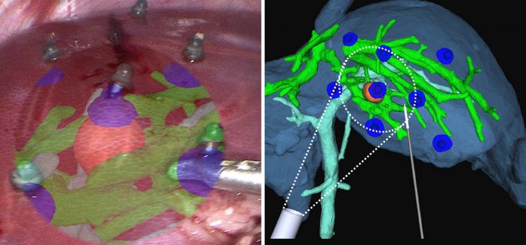 Tomorrow starts #ShiftMedical. Read my interview with Egidijus Pelanis, a medical doctor at Oslo University Hospital, about applying #extendedreality in the operating room. @Shift_Medical #futureofsurgery tectales.com/ar-vr/xr-is-fu…