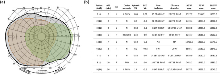 AAOjournal's tweet photo. Unilateral congenital #cataract removal appears beneficial in improving the binocular visual field, even in cases with poor visual acuity https://t.co/RJMwBK2LNc #ophthalmology #pediatrics #cataractsurgery #aphakia https://t.co/KVfpmyOVGv