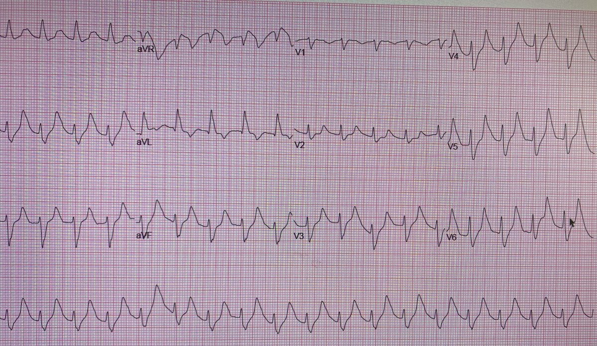 ysjimenez18's tweet image. Acute onset AMS. 
Solitary kidney. 
This is what potassium of &amp;gt;10 looks like 😳
STAT HD!! 
#MedTwitter #IMlife @najahakhan