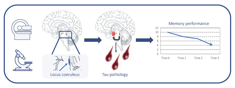 In a new publication in Science Translational Medicine, the @DrHeidiJacobs and Johnson labs have used #MR and #PETimaging to show that the #locuscoeruleus is associated with features of #AlzheimersDisease. 

gordon.mgh.harvard.edu/gc/locus-coeru…