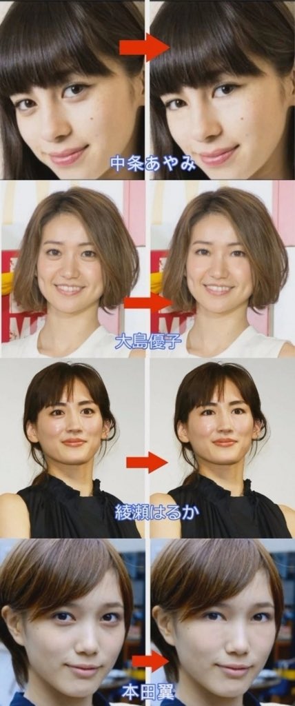 りん眼瞼下垂dt 整形olバレたら死ぬ 涙袋がなくなっても綺麗なままの人もいるけど 涙袋がないだけで笑顔がなんだか胡散臭くなる 笑った時の柔らかい表情も涙袋が作ってるのね 人の目元の印象は目と涙袋のコンビで完成することが分かった T Co