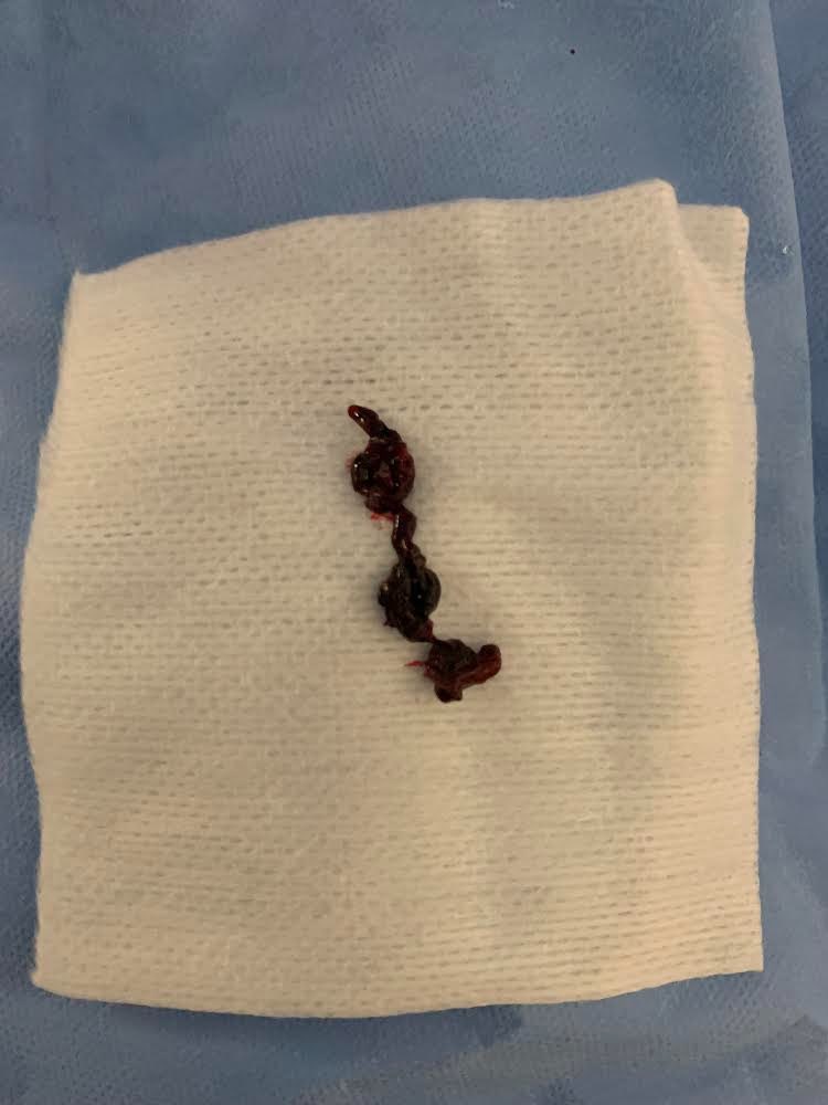NeurosurgeryOSU's tweet photo. Ohio State Neurosurgery all women stroke team in action performing a thrombectomy! https://t.co/cZegMMVvYp