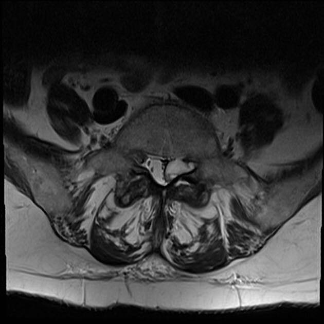 Q: 75yo female with left sciatica. What is the cause?
ANSWER: bit.ly/2kLB6IP
#FOAMrad #FOAMed