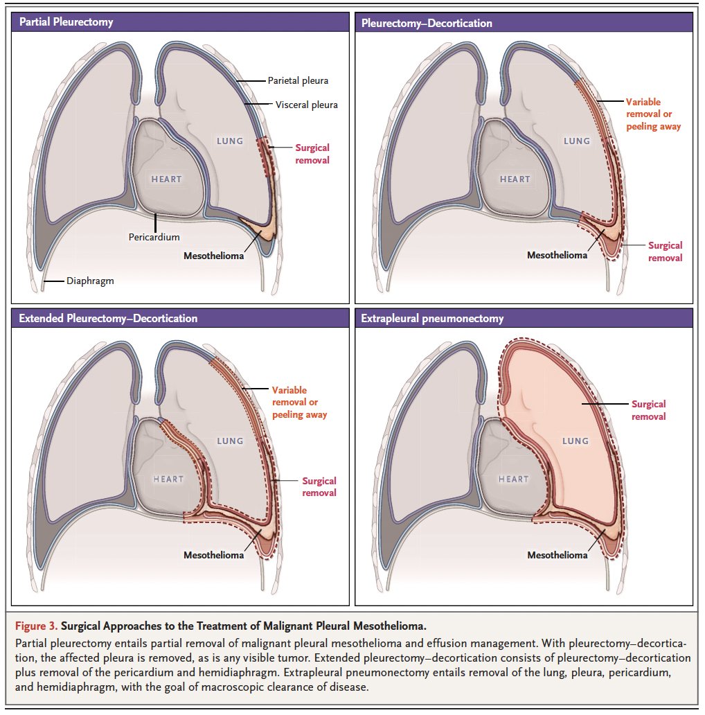 mesothelioma and vomiting