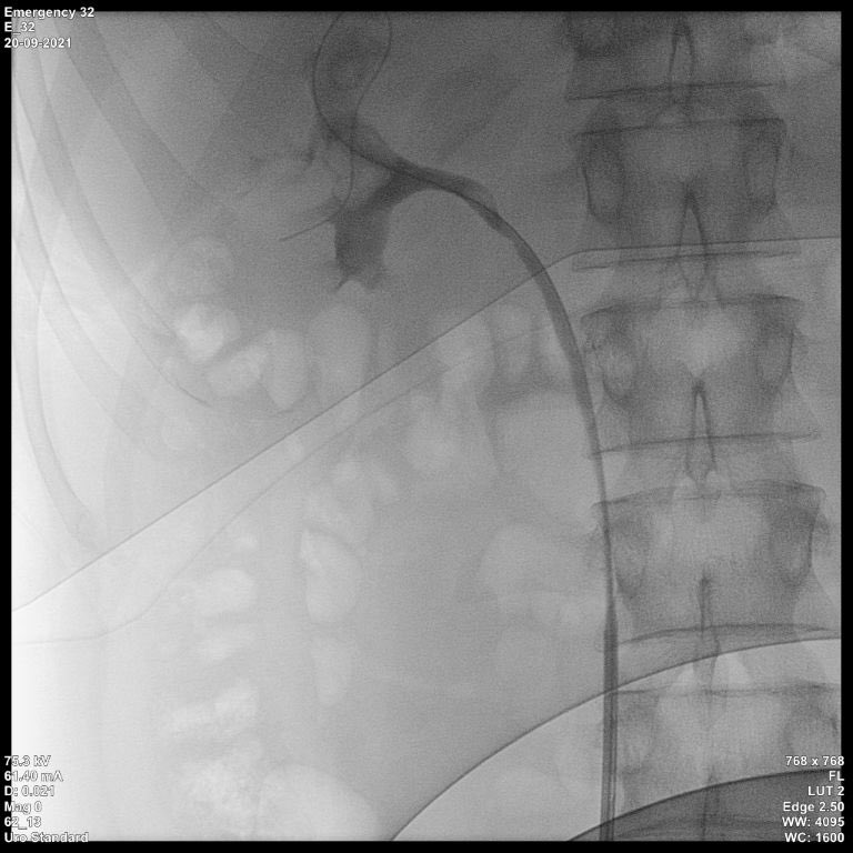 GuidoGiusti's tweet photo. Size does matter in #endourology: today we could negotiate a tiny ureter only because we had the brand new 7.5 @PusenMedical #disposable #urs &amp; some tricks of the trade: scope through rigid sheath to overcome a disturbing bladder looping.. key is anyway to not push too much #ETCE https://t.co/YoR4kXqDXc