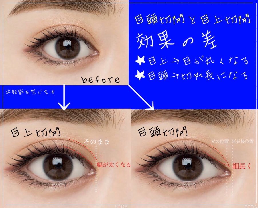 目上切開 Twitter Search 目上切開 Twitter Search