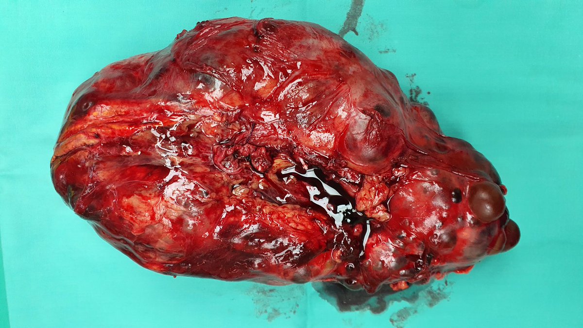 This is how a polycystic kidney look like after it is removed. The size is bigger than your head 😅