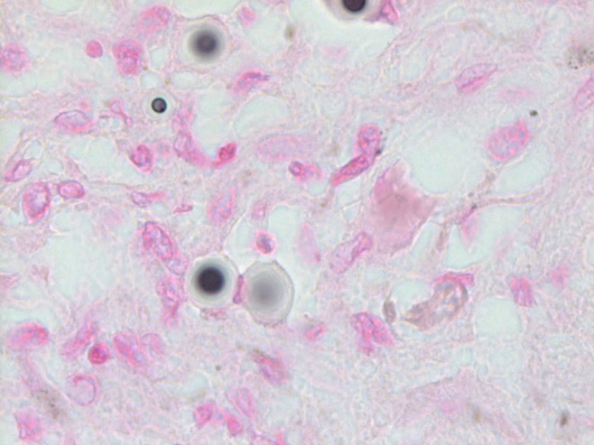 IBMScience's tweet photo. Microbiology Case Study: a 67 year old male with type II diabetes, hypertension, hyperlipidemia, obstructive sleep apnea, recurrent GI bleeds, and atrial fibrillation developed severe leg pain... https://t.co/XJpYQ8OvkR https://t.co/GEhbFSfux4