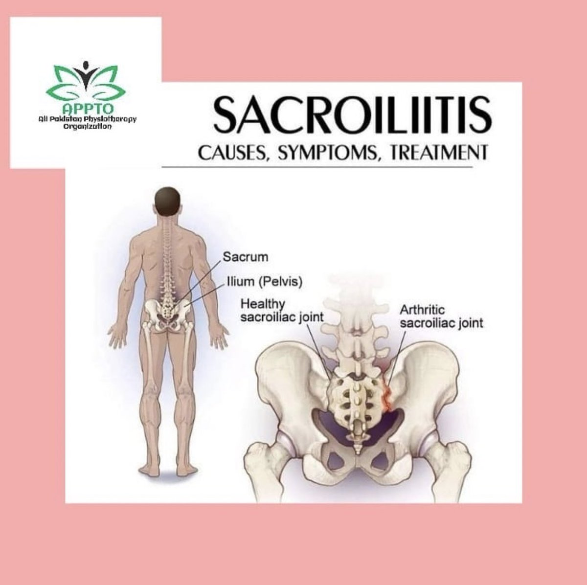 APPTO17's tweet photo. Sacroiliitis is the inflammation of one or both sacroiliac joints 
It is the common source of lower back pain 
Check Insta for details

https://t.co/iTYsp9uRMd https://t.co/HcuM6JA7k1