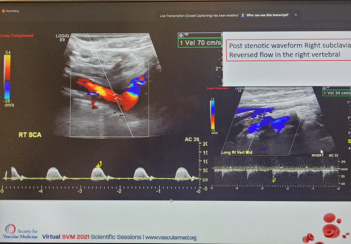 stanhenkin's tweet photo. Friend and mentor Dr. Casanegra presenting a case of large vessel #vasculitis. #vascularmedicine is so cool, combining history, #PE, #imaging to make the #diagnosis! @SVM_tweets #SVM21. https://t.co/sl6J1PmQge