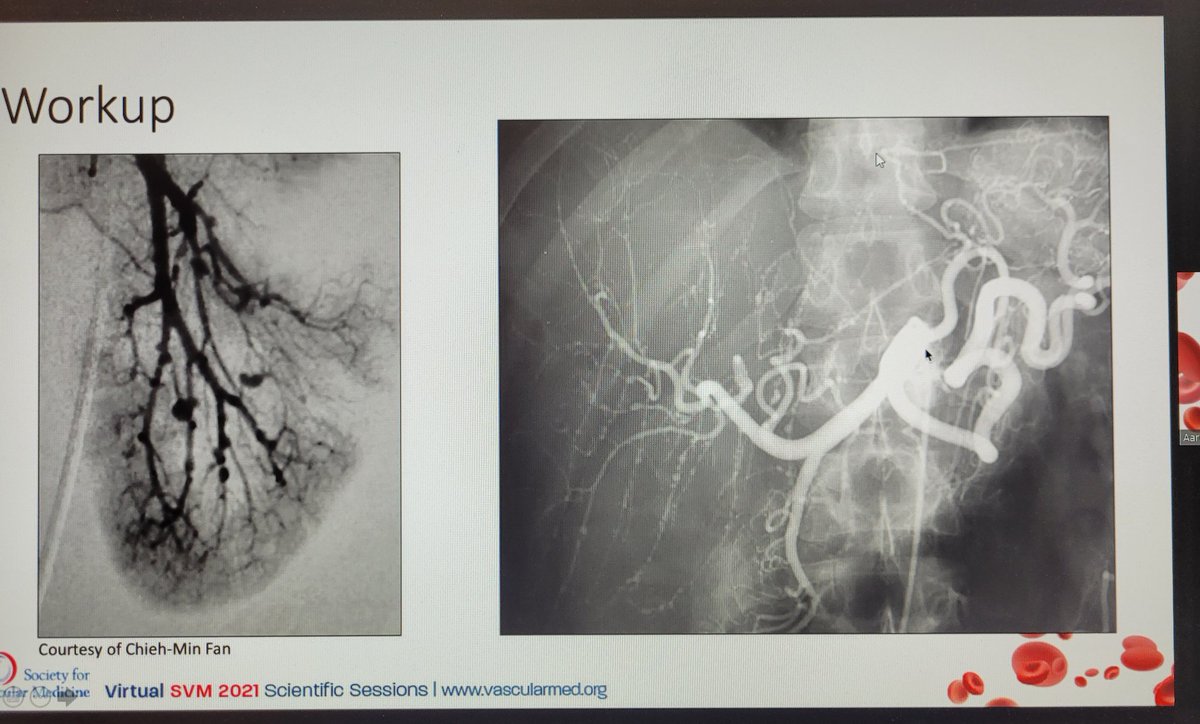 stanhenkin's tweet photo. A wide differential for #livedo! @AaronAdayMD presents a case of #PAN @SVM_tweets #SVM21 https://t.co/WDlhYdgeRs