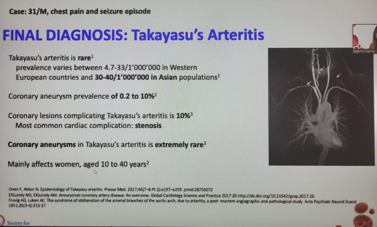 stanhenkin's tweet photo. I learn something new from every presentation @SVM_tweets #SVM21 - this time #Takayasu in a young patient with #STEMI and seizures. Coronary aneurysms can be seen in #Takayasu. @Angiologist @heatherlgornik @EstherSHKimMD @DKadiandodov @AaronAdayMD @DrMarkCreager https://t.co/j6AneNkXBY