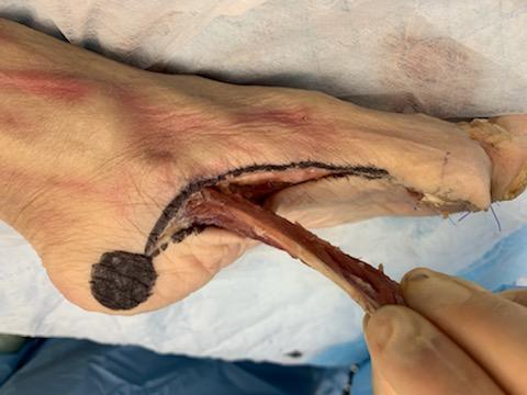 DpmNaren's tweet photo. Hosted a #muscleflap lab for our #podiatry residents this morning. Great time teaching and learning! @UofAZSurgery @ArizonaPodiatry @VascularAz #limbsalvage #plasticsurgery #ortho https://t.co/6rtM0E1xYY
