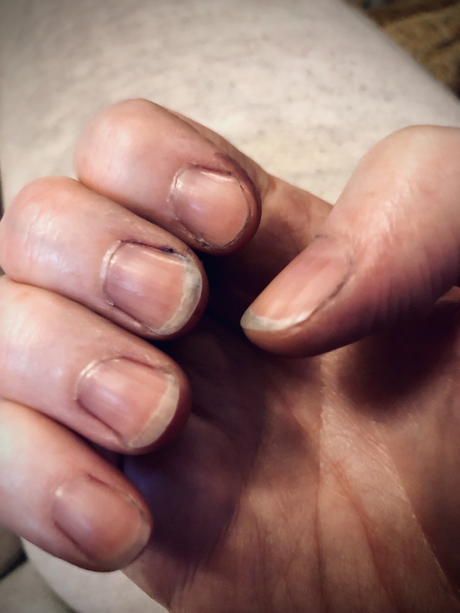 harkherold's tweet photo. Pro tip 😖:
When making homemade 🍇grape jam, WEAR GLOVES, and dark clothing.
My hands, nails, sink, utensils, &amp; towels are stained purple. And my comfy grey sweats are now grey and PURPLE SPECKLED sweats. 
Luckily, my shirt was already purple!
Yay me.😑
#Sundayjamsession #foodie https://t.co/UFM4VcvpHK