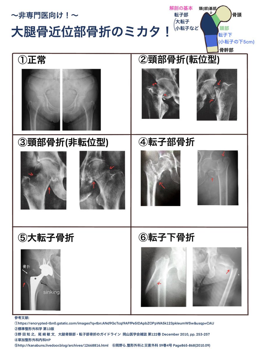 orthopedic_ham's tweet photo. 【大腿骨近位部骨折】
非整形外科向けに基本のキをまとめました。
骨折の種類、股関節Xp正面の見るポイント、そして実際のXpで復習を2枚でできるようにしました。
間違っている点やご質問があればよろしくお願いします。

#頸部骨折
#頚部骨折
#���子部骨折 
#大転子骨折 
#転子下骨折 https://t.co/5f5vxdtCmv