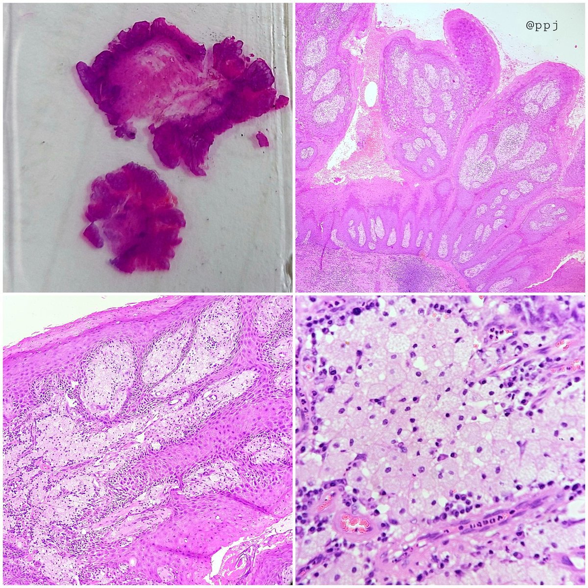 padmapathology1's tweet photo. Vegas - verruciform genital associated xanthoma involving the prepuce
⬇️⬇️

#kapcon2021
#kapconpathtweet 
#PathTwitter 
#gupath https://t.co/30ovHSFXNM