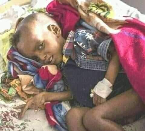 ተጀንሯል
Millions of people in TPLF invaded North Wollo, Amhara region is languishing with severe malnutrition&amp; starvation. Emergency food aid NOW! 
#UrgentHelptoWollo 
#WolloCantWait 
<a href="/OCHA_Ethiopia/">UN OCHA Ethiopia</a> 
<a href="/DanielBekele/">Daniel Bekele</a> 
<a href="/AJEnglish/">Al Jazeera English</a> 
<a href="/BBCBreaking/">BBC Breaking News</a> 
<a href="/POTUS/">President Donald J. Trump</a> 
<a href="/Reuters/">Reuters</a> 
<a href="/Telegraph/">The Telegraph</a>