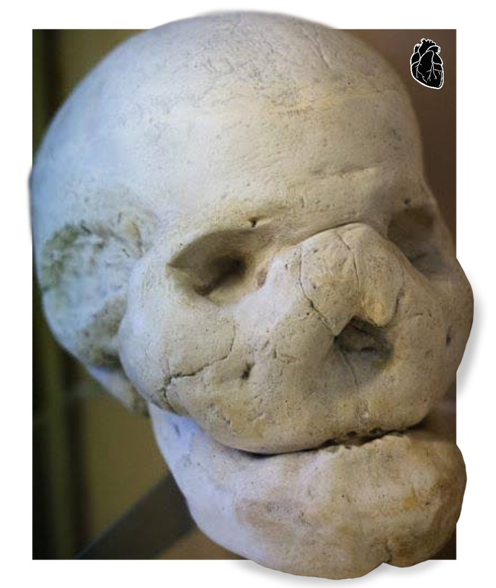 La leontiasis ossea, también conocida como cara de león, es una afección médica muy rara, caracterizada por un crecimiento excesivo de los huesos faciales y craneales.

Causa la deformidad de la cara, exoftalmos y al final la muerte por compresión cerebral.