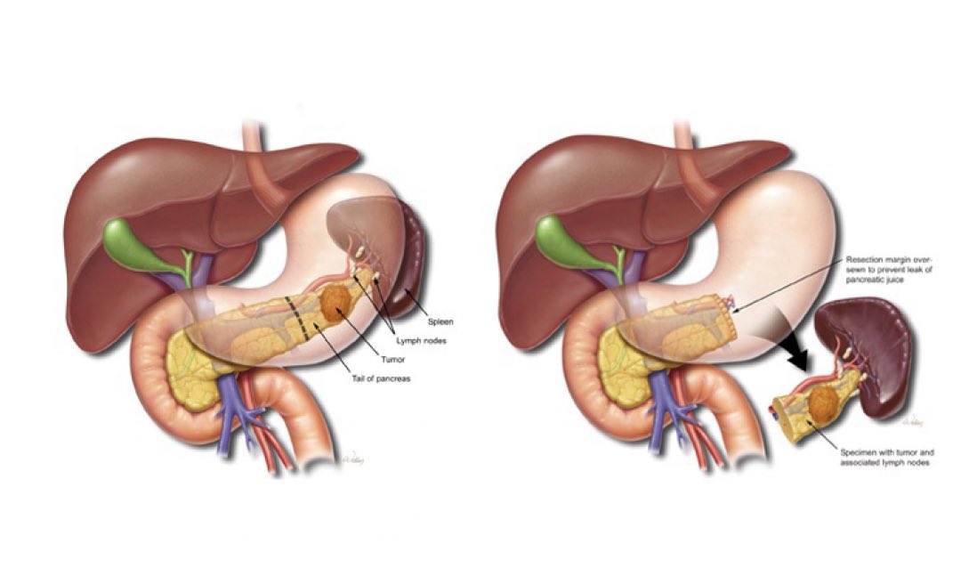 Поджелудочная и селезенка одно и тоже. Спленэктомия операция. Панкреатодуоденальная резекция операция Whipple. Дистальная резекция поджелудочной железы этапы операции. Панкреатодуоденальная резекция ход операции.