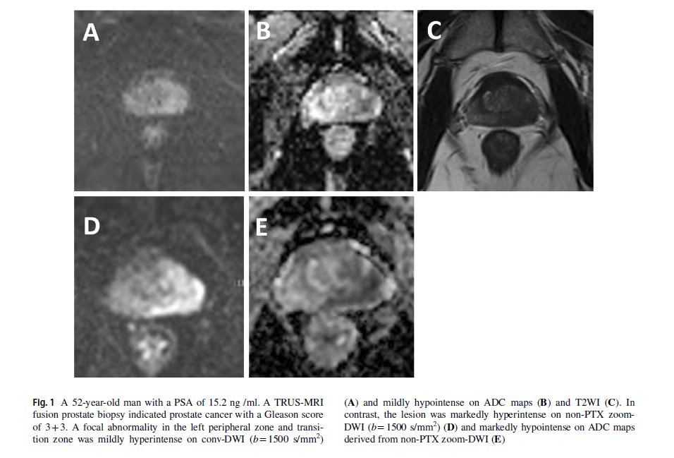 radiolobt's tweet image. Better lesion conspicuity translates into improved prostate cancer detection: comparison of non-parallel-transmission-zoomed-DWI with conventional-DWI 
link.springer.com/article/10.100… #prostateMRI #prostatecancer #medtwitter #CancerResearch