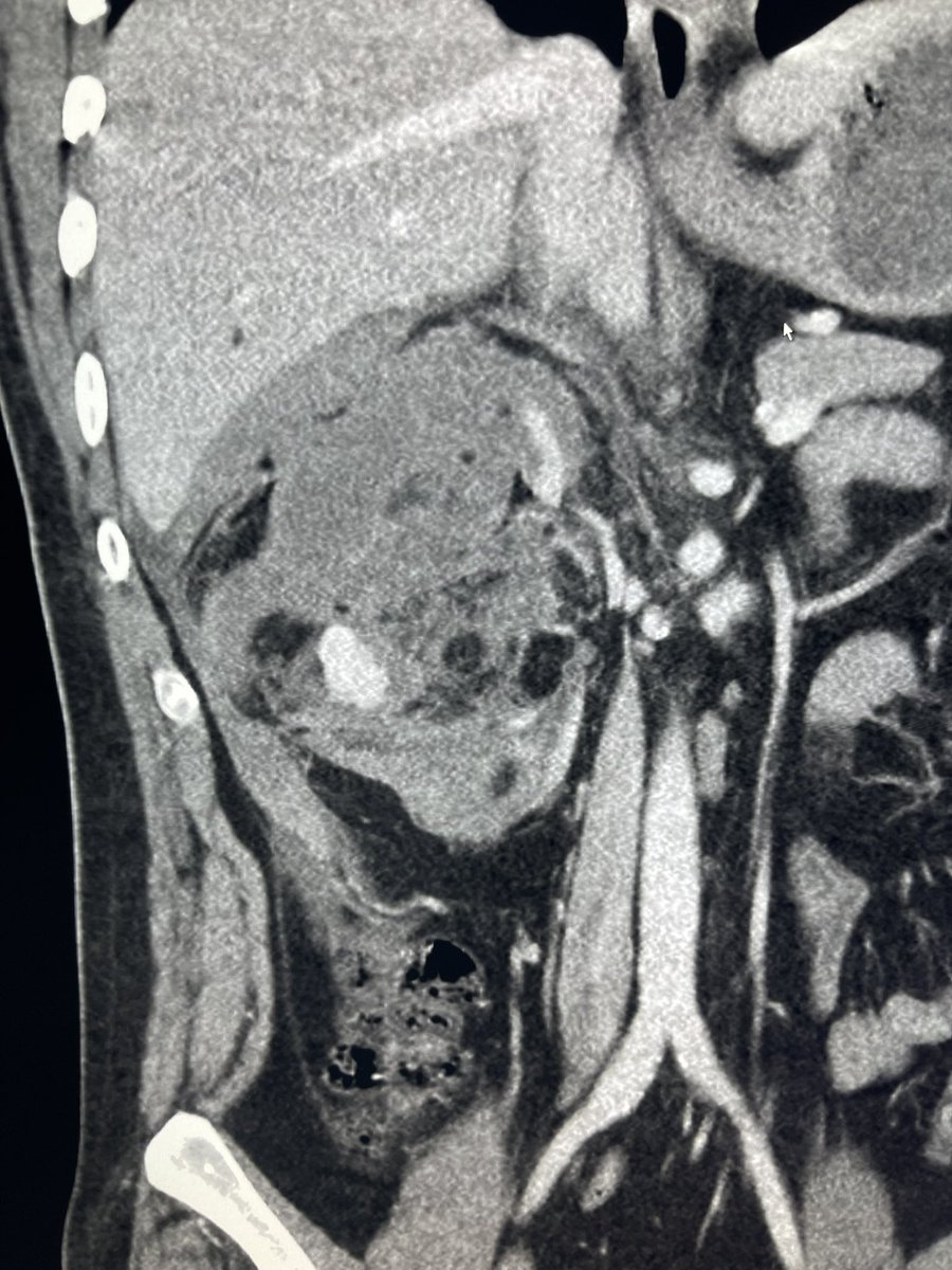 milanpatelMD's tweet photo. Always on a Friday at 5pm. Young male lifeflighted with ruptured AML. Almost looks like a shattered kidney. Urology considering urgent nephrectomy. #IRad with maximum nephron sparing therapy @HCIRad @jdkubanMD @rahulshethmd https://t.co/DX6iZBfzpd