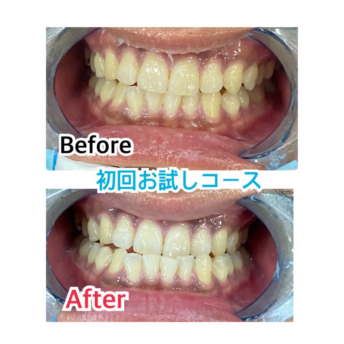 柏ホワイトニング専門店 Platinumbeauty Pbkashiwa22 Twitter 柏ホワイトニング専門店 Platinumbeauty Pbkashiwa22 Twitter