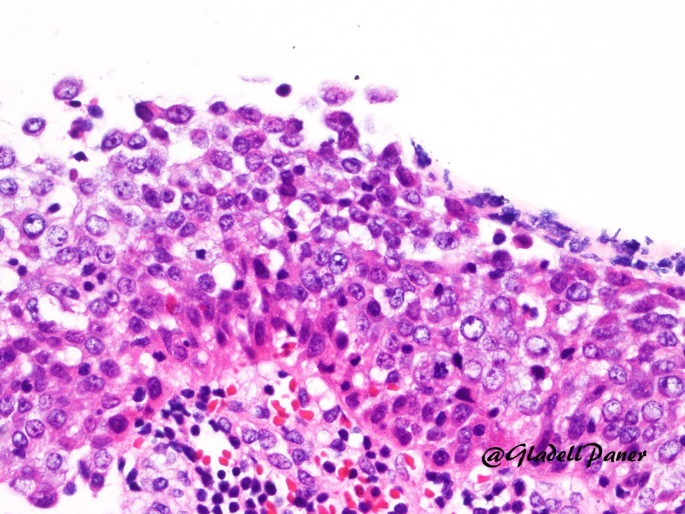 How does CK20 immunostain helps in diagnosing Urothelial Carcinoma in Situ?

👉 Full thickness staining.

Reactive urothelium will be positive only in surface umbrella cells or completely negative. #Bladder #GUPath