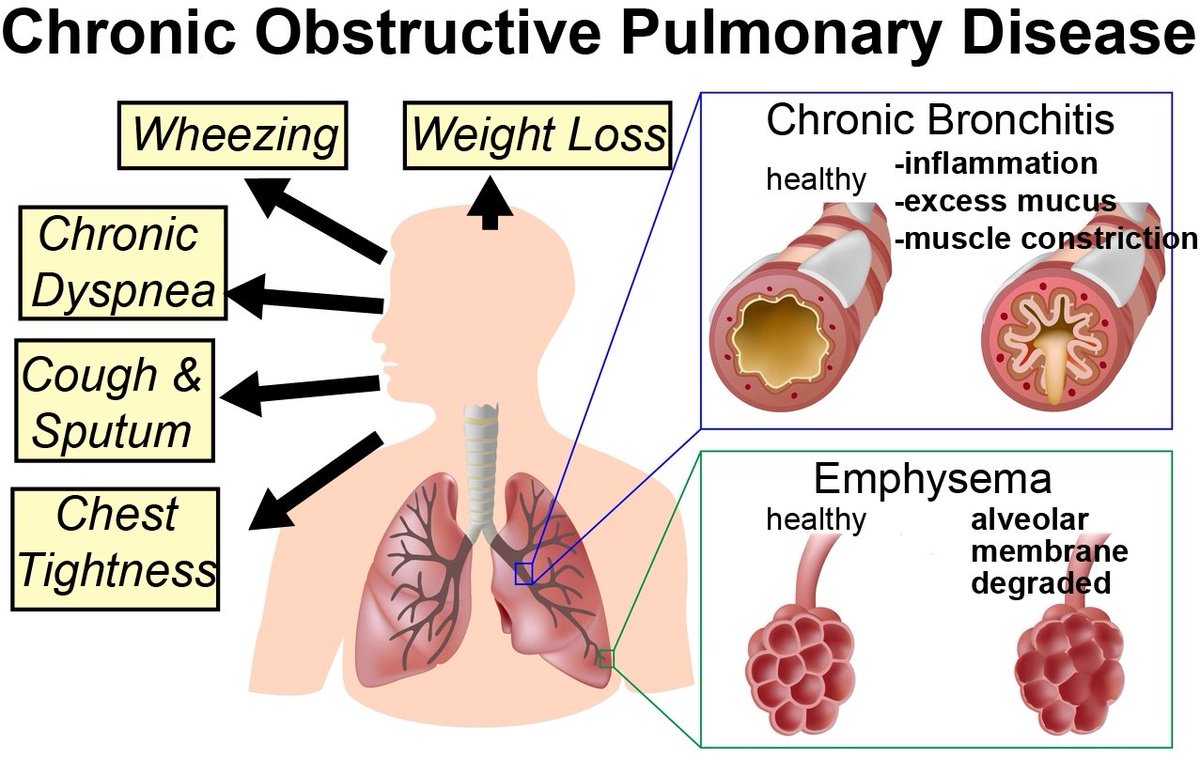 Эмфизема хронического бронхита. Chronic obstructive Pulmonary disease (COPD). Хроническая обструктивная болезнь легких (ХОБЛ).