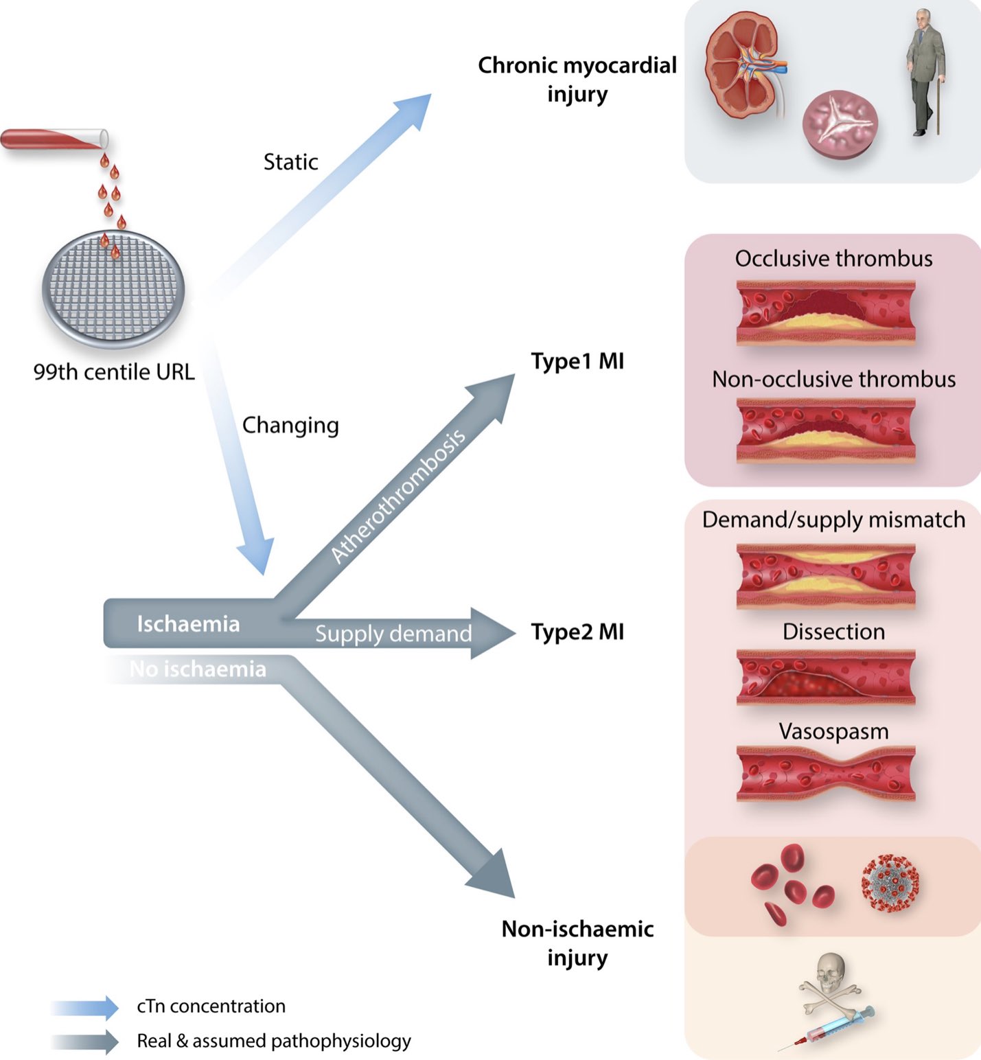 Cvr Tomasz Guzik On Twitter Must Read State Of The Art Review Explores Cardiac Troponin Defining Mi Including The 4th Universal Definition Of Myocardial Infarction Necessary Adjustments In Clinical Guidelines Discover More Https T Co