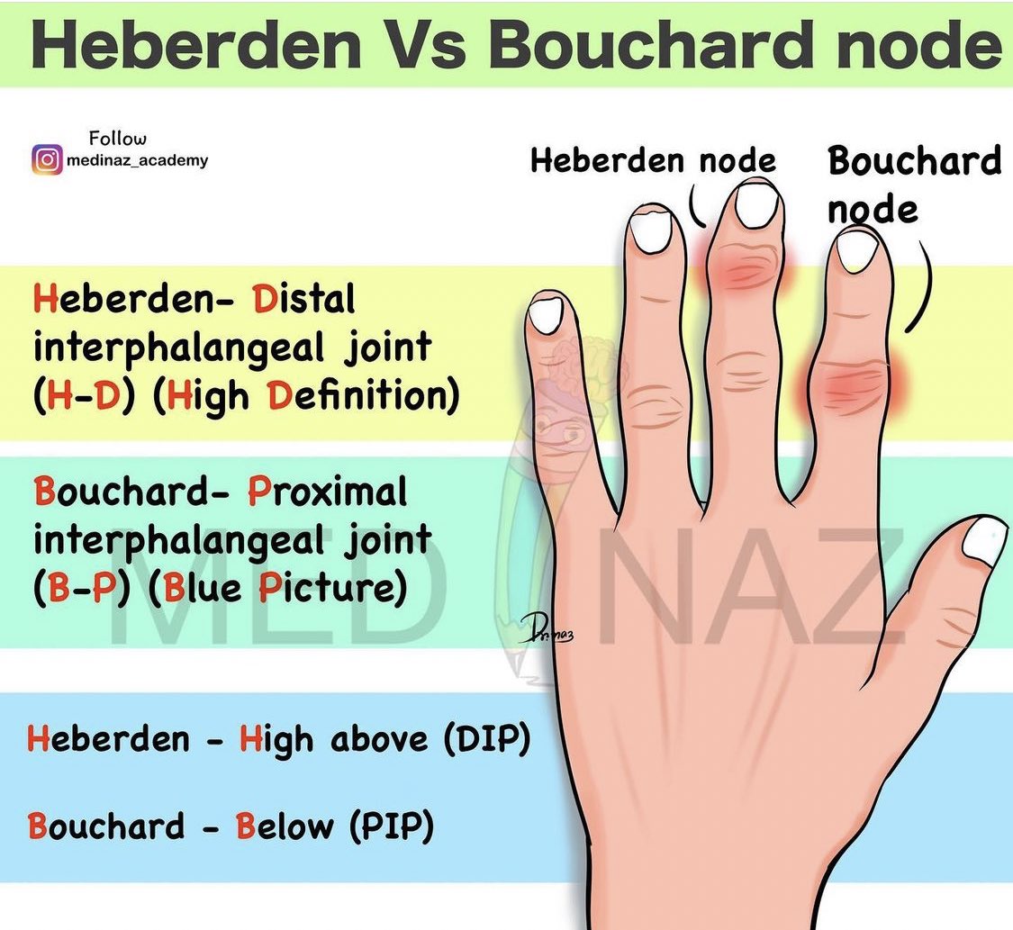 Osteoarthritis Nodes Heberden And Bouchard Nodes