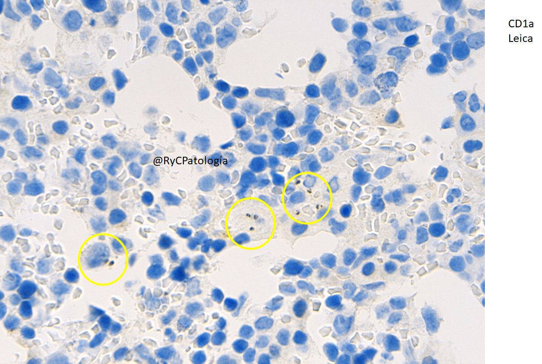 RyCPatologia's tweet photo. ➡️ Síndrome constitucional, fiebre, pancitopenia. 
➡️ Biopsia de médula ósea.
➡️ Inmunohistoquímica: CD1a de Leica.

🔬 Leishmaniasis visceral.
☑️ Positividad cruzada con CD1a de Leica.
#Hemepath #bugpath #RyCPath https://t.co/v391X26SQs