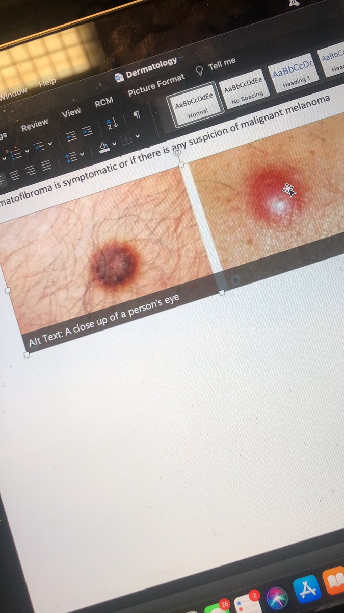 So I’m making notes on dermatology and Microsoft Word’s automatic attempt at describing the image pasted from a website is quite funny