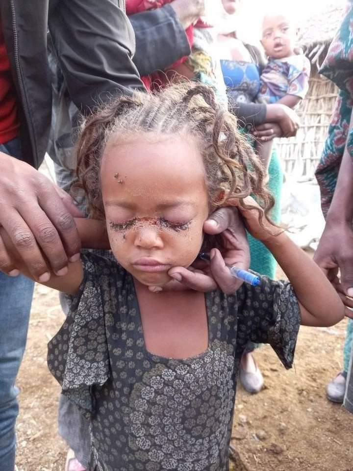 AberaMula's tweet photo. @dejene_2011 @UN @WFP @UNOCHA @SamanthaJPower @UNReliefChief @EU_Commission @AJEnglish @FoxNews @HouseForeign @StateDept @NeaminZeleke @ArayaTesfamari1 @StateDept @UN_HRC @POTUS @PowerUSAID @SecBlinken @JoeBiden @UN @UN_Spokesperson @UNICEF
Over 1million civilians in north wello displaced &amp;starved due to #TPLF rebels war aganist Amhara region.civilians are surended in jangil😭&amp;chilederens are in pain of diseases as result of war https://t.co/SmKVfrggK2