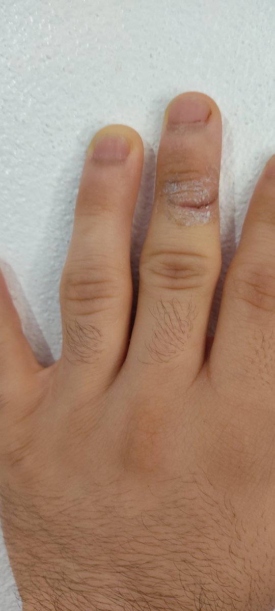EL3CTRO_CAT's tweet photo. Pues ya no se ve tan mal la herida, pero fue tan profunda que pasados 10 dias aun me duele y no puedo usar el teclado tanto... nos nerfearon banda. Ahora me faltan manos https://t.co/F1ZymPjlMV