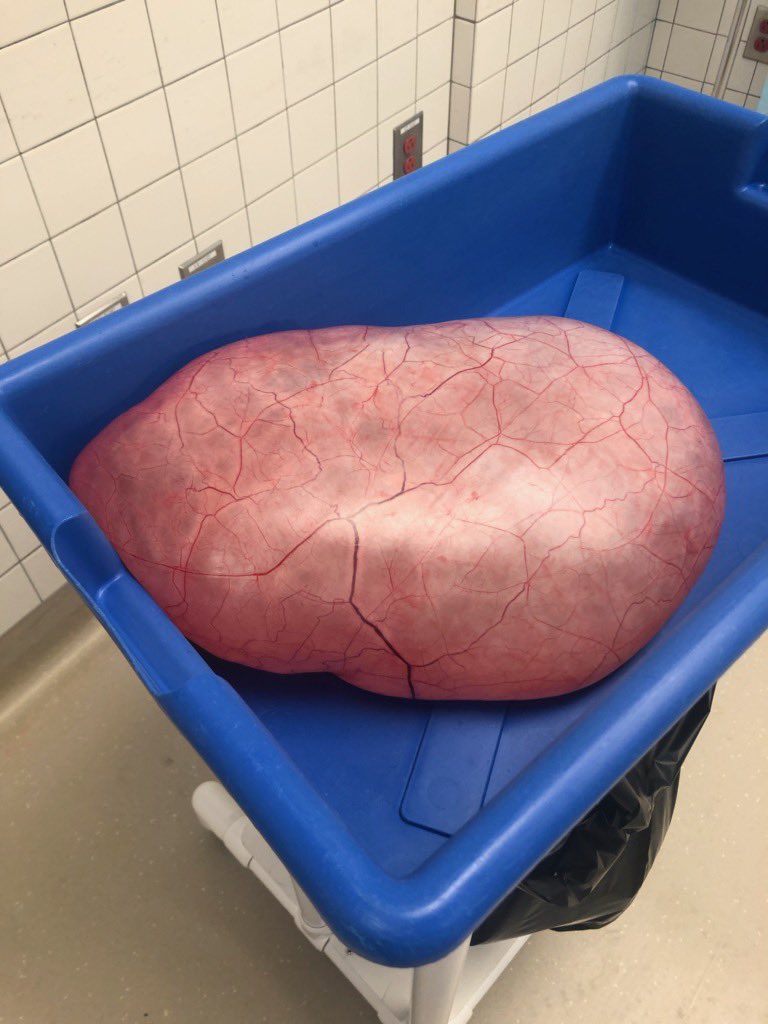 LaundyRye's tweet photo. Hi, my name is Rileigh, and this is my 12 pound ovarian cyst. I’d like to share my story today, not only because it’s been a whole year that I’ve been tumor free, but because I need people to know what it’s like to be a teenage girl in the healthcare system. https://t.co/ApXnP3HNyV
