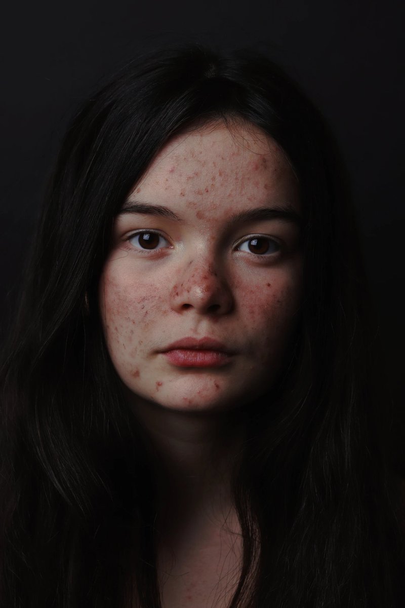 DrAdrianaHoly's tweet image. Feeling insecure about your wrinkles, spider veins, or acne scars? Excel V+ might give you your confidence back! Call us today to see if this is the right treatment for you:
qoo.ly/3d22yy
#ExcelV+ #LaserTherapy