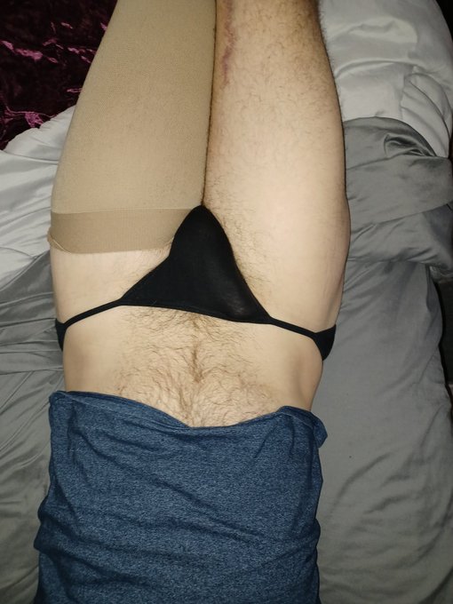 Right leg is healing nicely, left leg is actually a lot better than the right. I'm hoping this is done