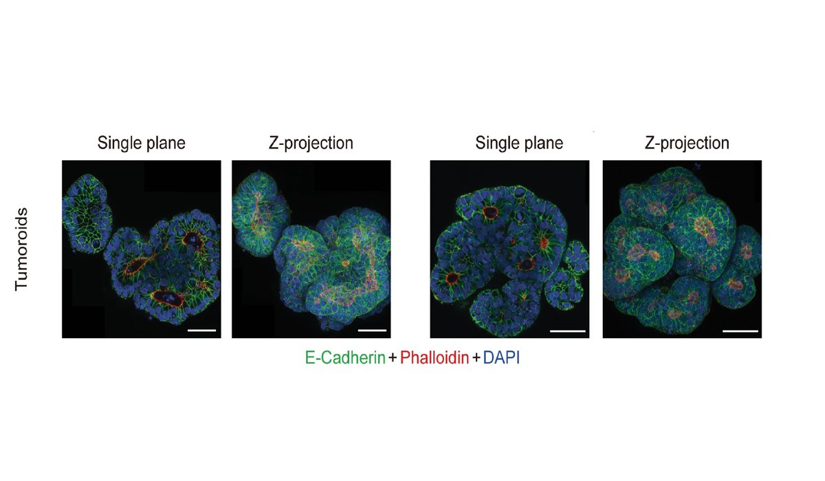 Scientists describe a reliable low-viscosity matrix suspension culture method for the growth of #organoids and #tumoroids from the human large #intestine.

📌 go.nature.com/2Xd8ZFw