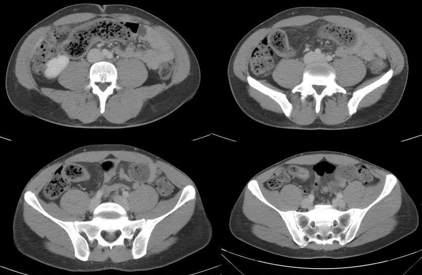RadiologyCored's tweet photo. Characteristics of Crohn’s disease include terminal ileitis, creeping fat, and upstream obstruction secondary to an ileal stricture. #radres #radcases #radiology #medtwitter https://t.co/P8DkiUctQK