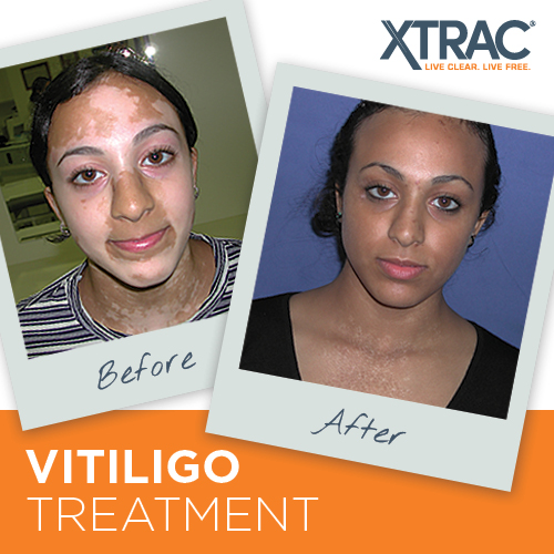 Have you seen what XTRAC can do for Vitiligo?  The results are AMAZING!  Call 800-814-9395 now to learn more about XTRAC treatment for Vitiligo and schedule a consultation with XTRAC dermatologist near you!

#xtrac #vitiligo #skin #dermatology
