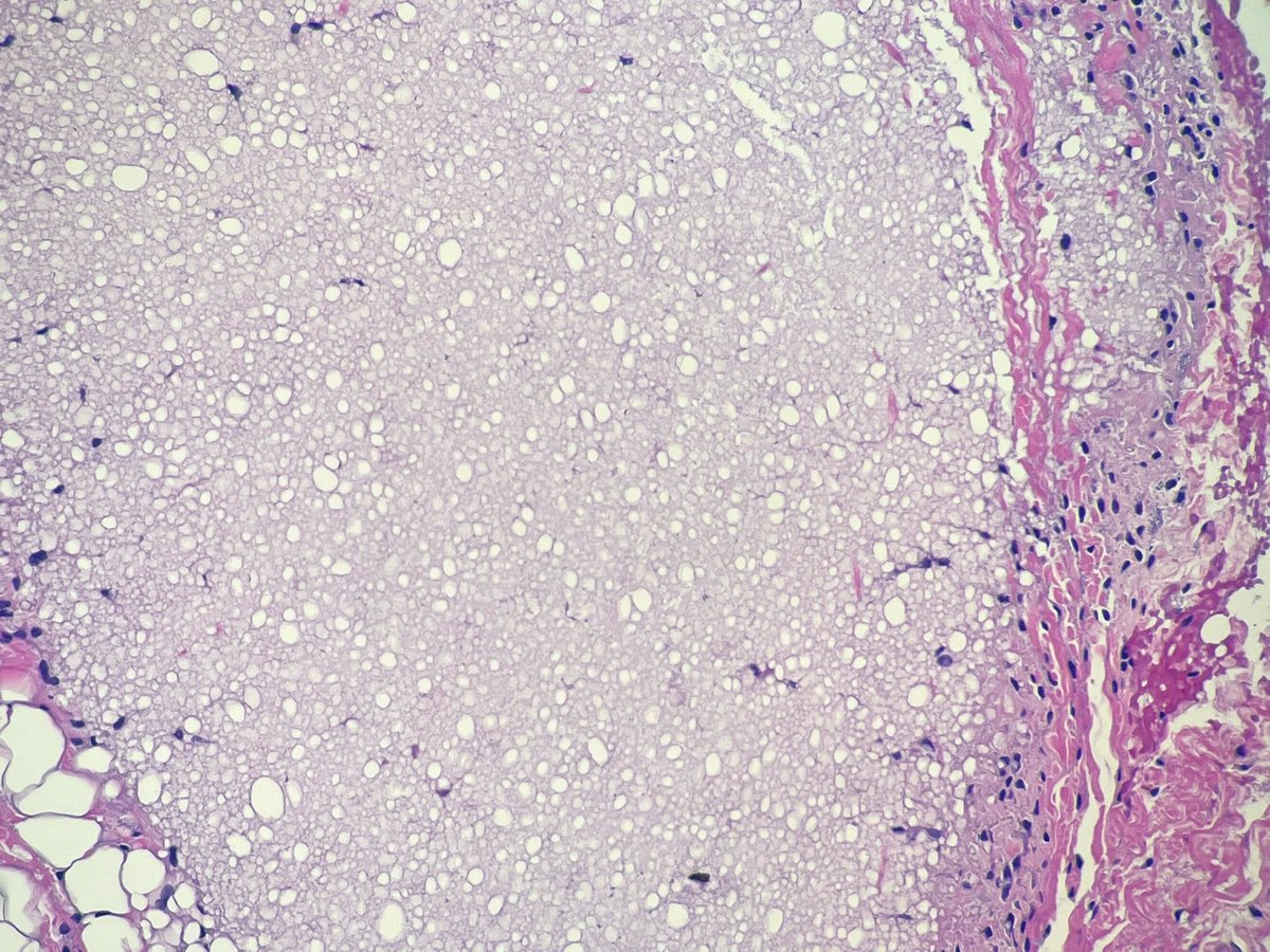 elimoreymd's tweet photo. Punch biopsy of intralesional kenalog, a glucocorticoid. This was injected to treat a keloid in the earlobe. Seen it in the books but never in person! #dermatology #dermpath #PathTwitter #MedTwitter #MedEd #Skin https://t.co/6kRBMODEEX