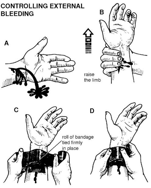 SEBARIN!
First aid in a nutshell
1. Demam >38 °C? Pamol
2. Meriang >37,5-38 °C? Bnyk minum air, kompres anget di ketiak, istirahat
3. Terkilir? RICE
4. Memar? Kompres es
5. Perdarahan? Hentikan perdarahan tutup&amp;tekan luka, angkat luka, balut
6. Luka bakar? Aliri air 10-20 menit