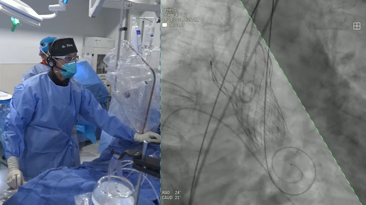 ccclivecases's tweet photo. Watch Live Evolut PRO TAVR for Severe Aortic Stenosis with Severe LVOT Calcium Now!
https://t.co/lLZG6WvdPN
@MDT_StructHeart @TAVRBot @GilbertTangMD @pmoreno143 @KHERA_MD #saminsharma #annapoornakini #interventionalcardiology #evolutpro https://t.co/ACi0b5v5ZN