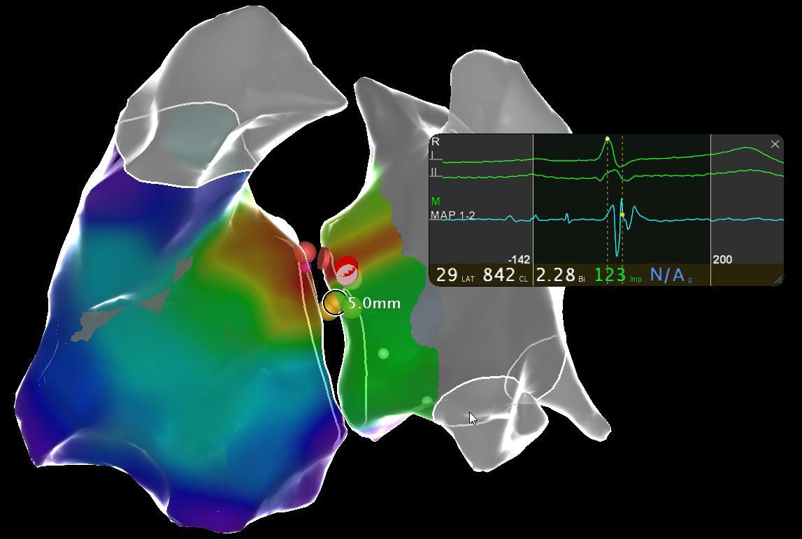Charles Guenancia (@guenanciac) on Twitter photo Happy to come back a week ago <a href="/CHRU_de_Nancy/">CHRU de Nancy</a> for parahisian AP ablation in a 37yo man, using Robotic Magnetic Navigation <a href="/Stereotaxis/">Stereotaxis</a>. Success site <5mm from His location (10->20W). No AV conduction alteration. Thanks to Pr C. de Chillou and all the EP team #EPeeps Happy to come back a week ago <a href="/CHRU_de_Nancy/">CHRU de Nancy</a> for parahisian AP ablation in a 37yo man, using Robotic Magnetic Navigation <a href="/Stereotaxis/">Stereotaxis</a>. Success site <5mm from His location (10->20W). No AV conduction alteration. Thanks to Pr C. de Chillou and all the EP team #EPeeps
