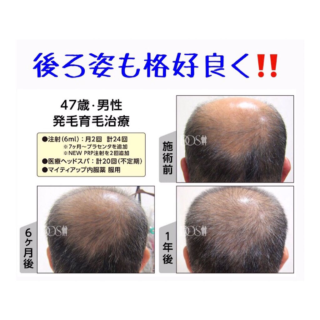 男たちの美容外科福岡院 Aga 薄毛治療専門クリニック Mens Do S Twitter